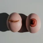 AstraZeneca और Daiichi का डेट्रोवे: advanced breast cancer उपचार में नई उम्मीद